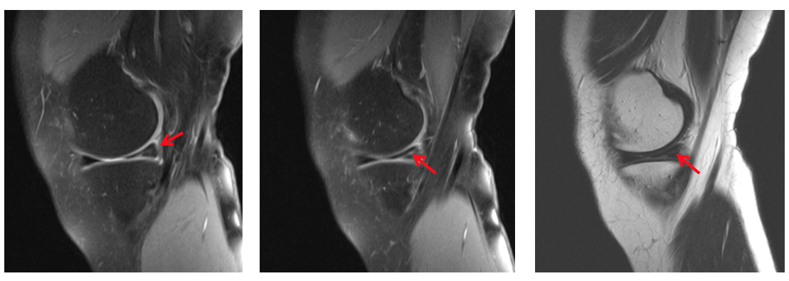 meniscus-surgery-meniscal-tear-colorado-knee-specialist