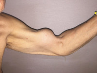 Popeye Deformity Rupture Of The Long Head Of The Biceps Tendon Dr