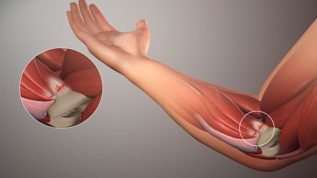 elbow pain after culrs