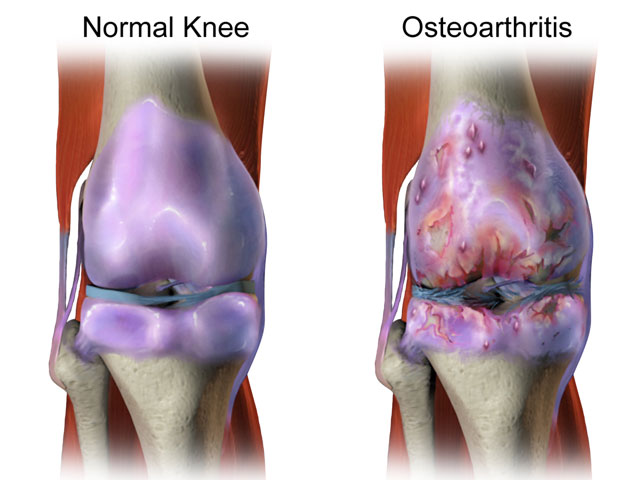 Knee Osteoarthritis Doctor | Colorado and Surgery | Colorado