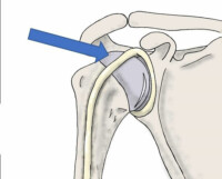 Bicep Tendon Tear | Bicep Rupture | Elbow Injury | Colorado