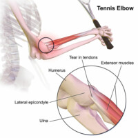 Tennis Elbow Doctor | Colorado and Surgery | Colorado