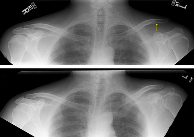 Acromioclavicular joint subluxation, Radiology Case