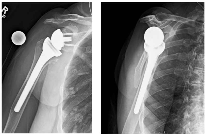 Shoulder Replacement Shoulder Arthritis Colorado