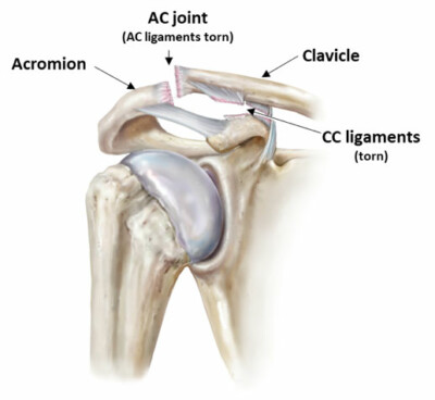 AC Shoulder Separation | Acromioclavicular AC Joint Pain | Vail, Denver ...