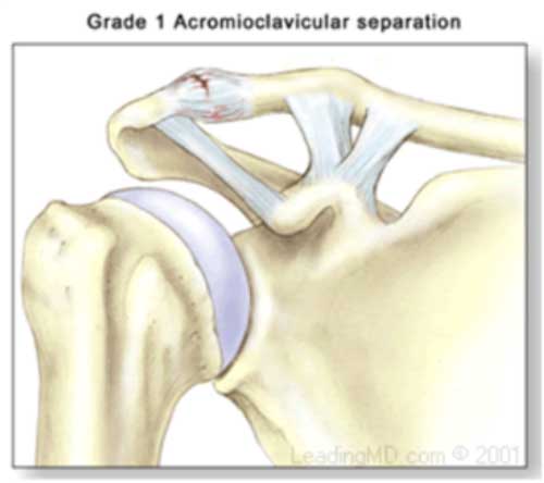 Grade 1 AC Joint Separation