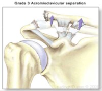 AC Shoulder Separation | Acromioclavicular AC Joint Pain | Vail, Denver ...