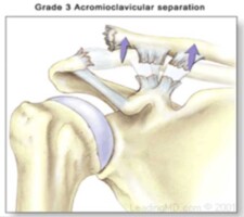 Grade 3 AC Joint Separation