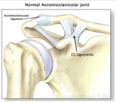 AC Joint Separation | Separated Shoulder | Vail, Aspen, Denver CO