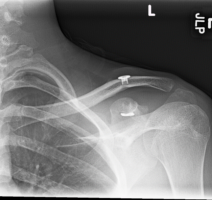 Post-Operative Shoulder Separation Surgery | Shoulder Separation | Colorado and Surgery | Colorado