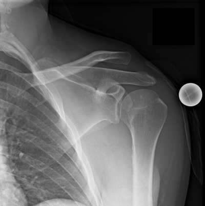 Shoulder Dislocation | Shoulder Separation | Vail, Aspen, Denver CO