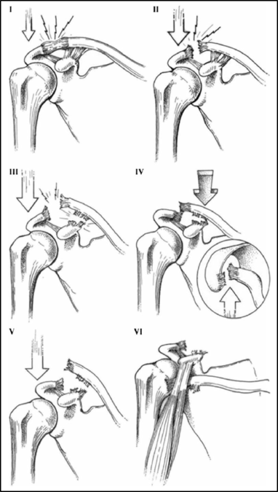 Shoulder Dislocation | Shoulder Separation | Vail, Aspen, Denver CO