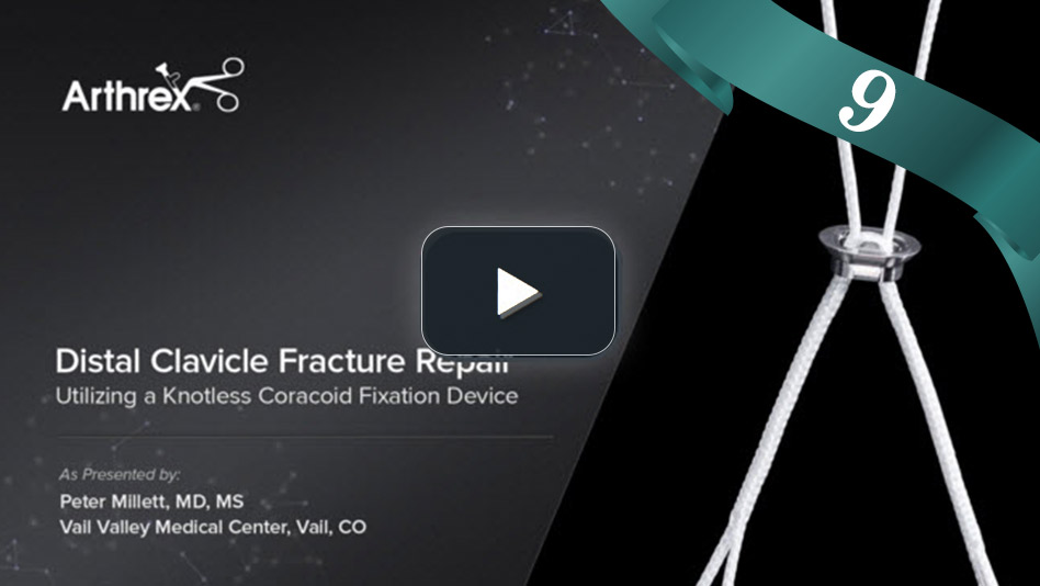 Distal Clavicle Fracture Repair