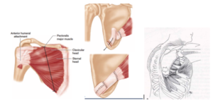 Pectoralis Major Tendon Transfer