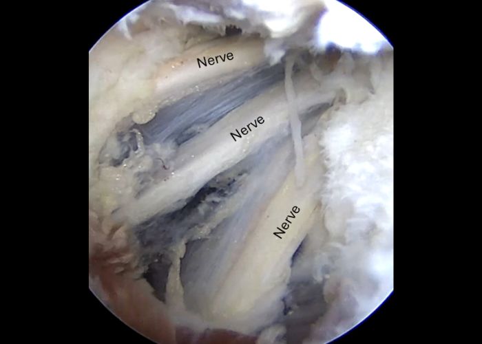 Axillary Nerve Scope Pic