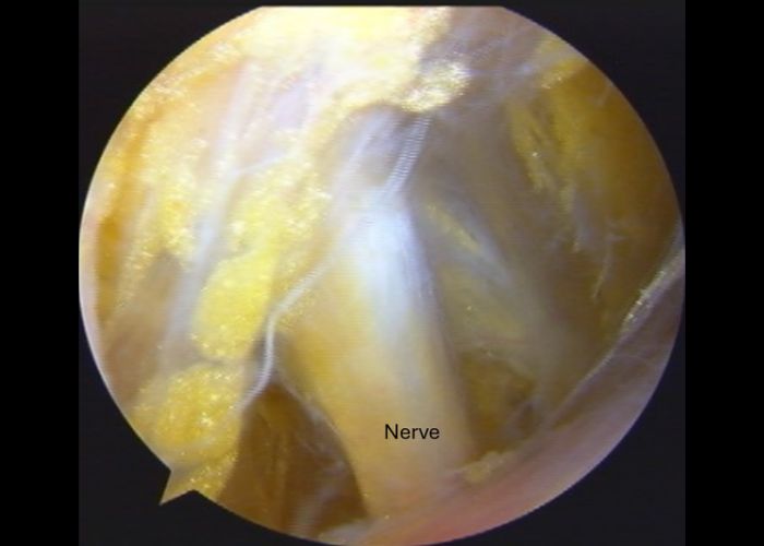 Brachial Plexus Scope Image