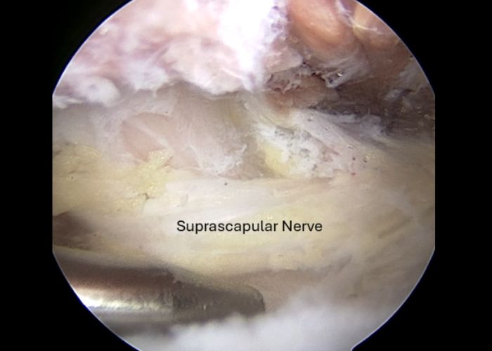 Suprascapular Nerve, Arthroscopic View